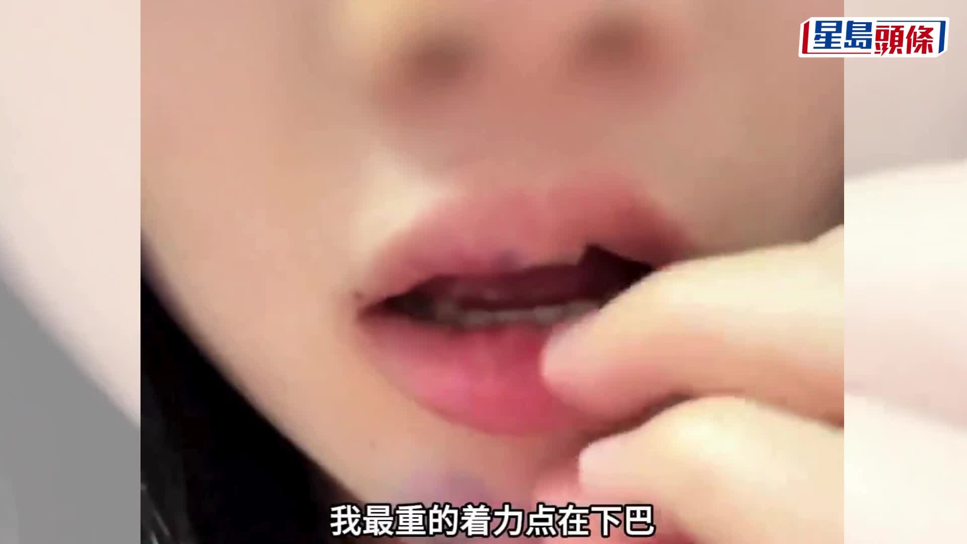 玩「笨豬跳」被推下血流披臉兼腦震盪，女子索賠疑遭拒。