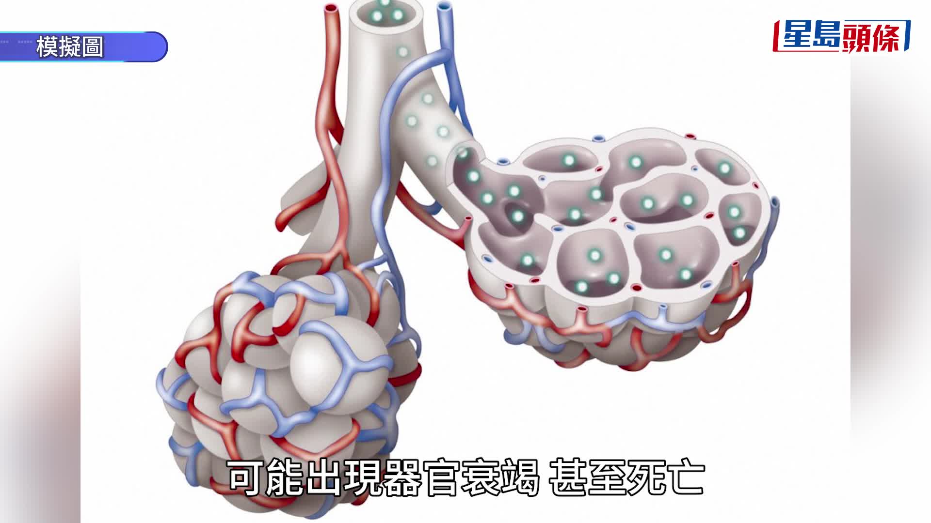 煙麴菌｜致命真菌入侵美國急速擴散 「從內部吞噬人體」