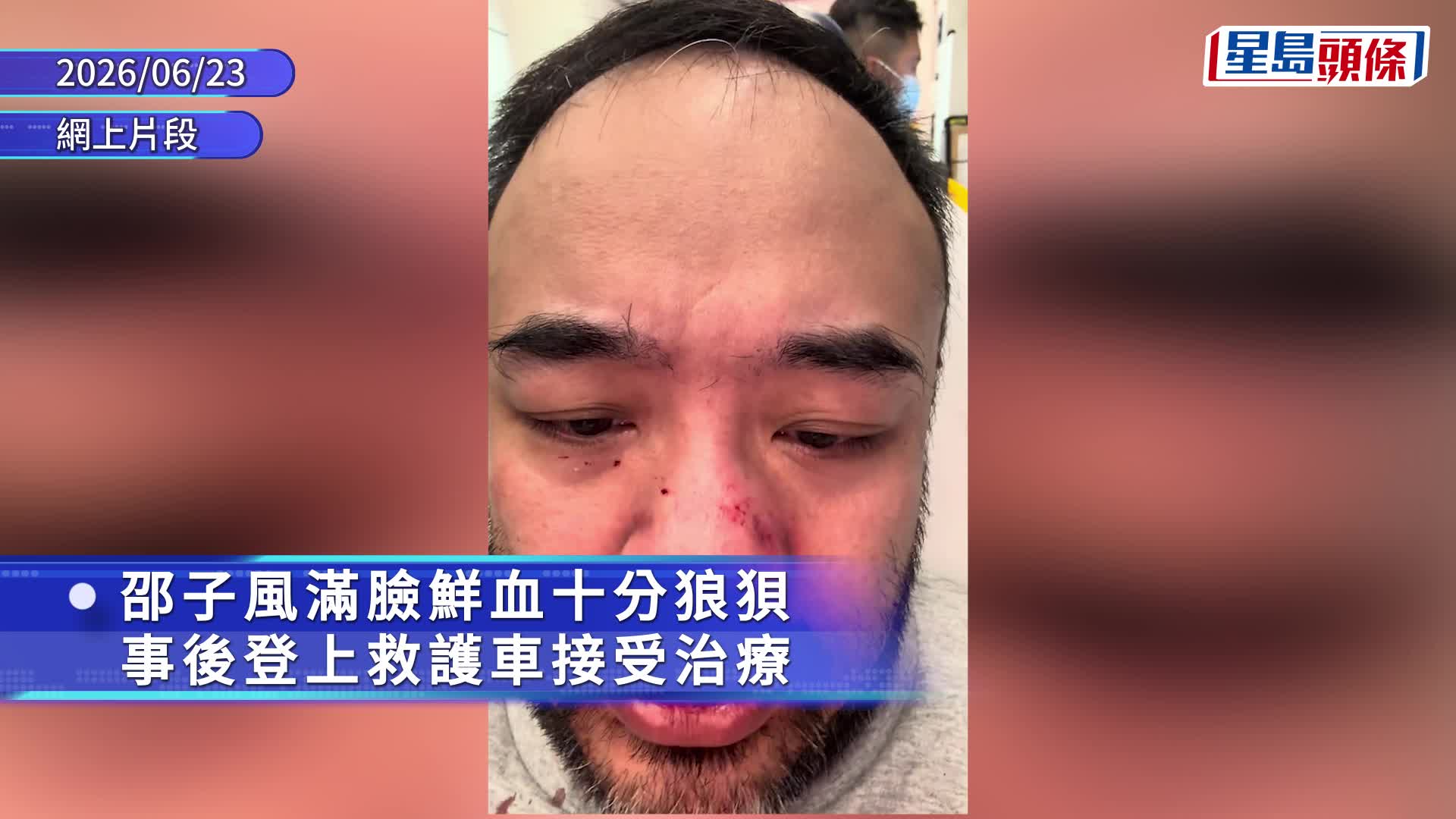 蝦頭舊愛邵子風直播被狂毆 遭光頭男連環揮拳打爆鼻血如泉湧