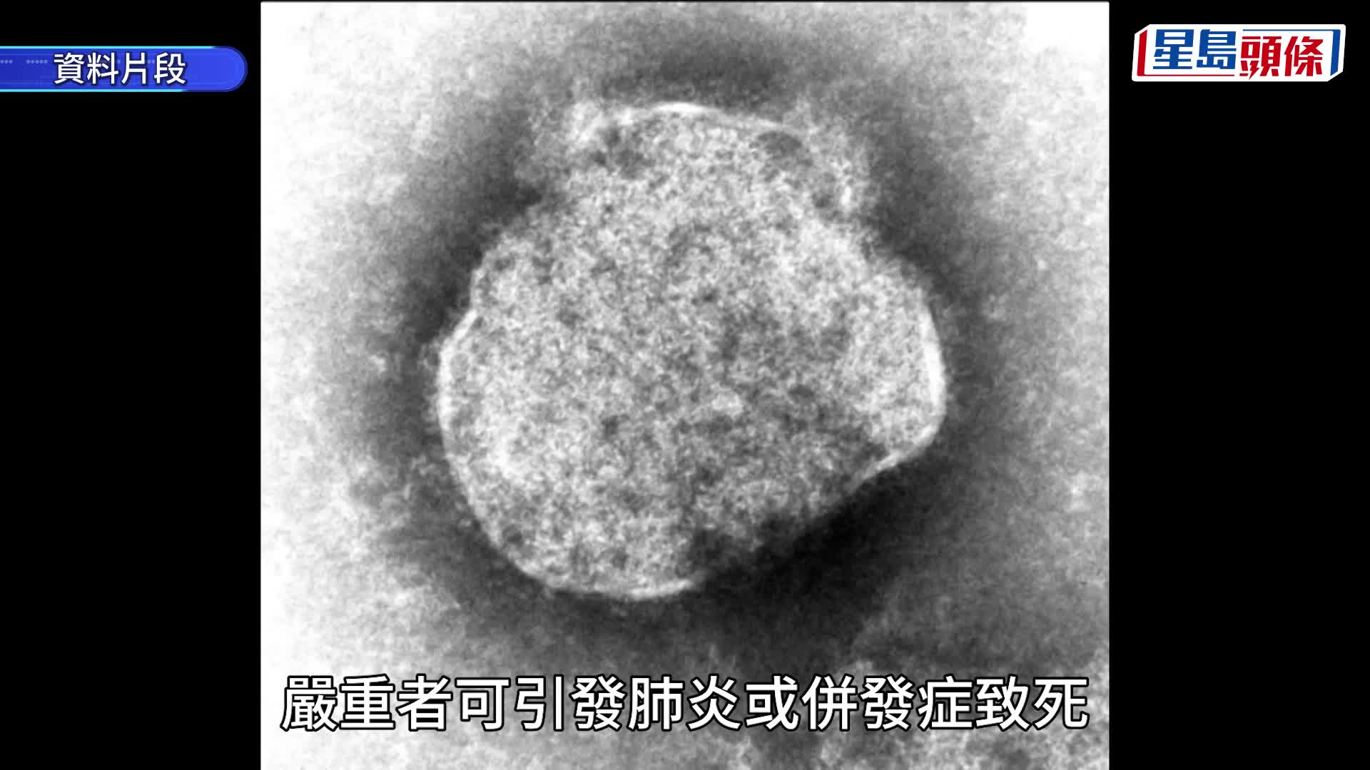 游日注意｜日本麻疹疫情大爆发 感染人数逼近10年高峰 东京沦重灾区