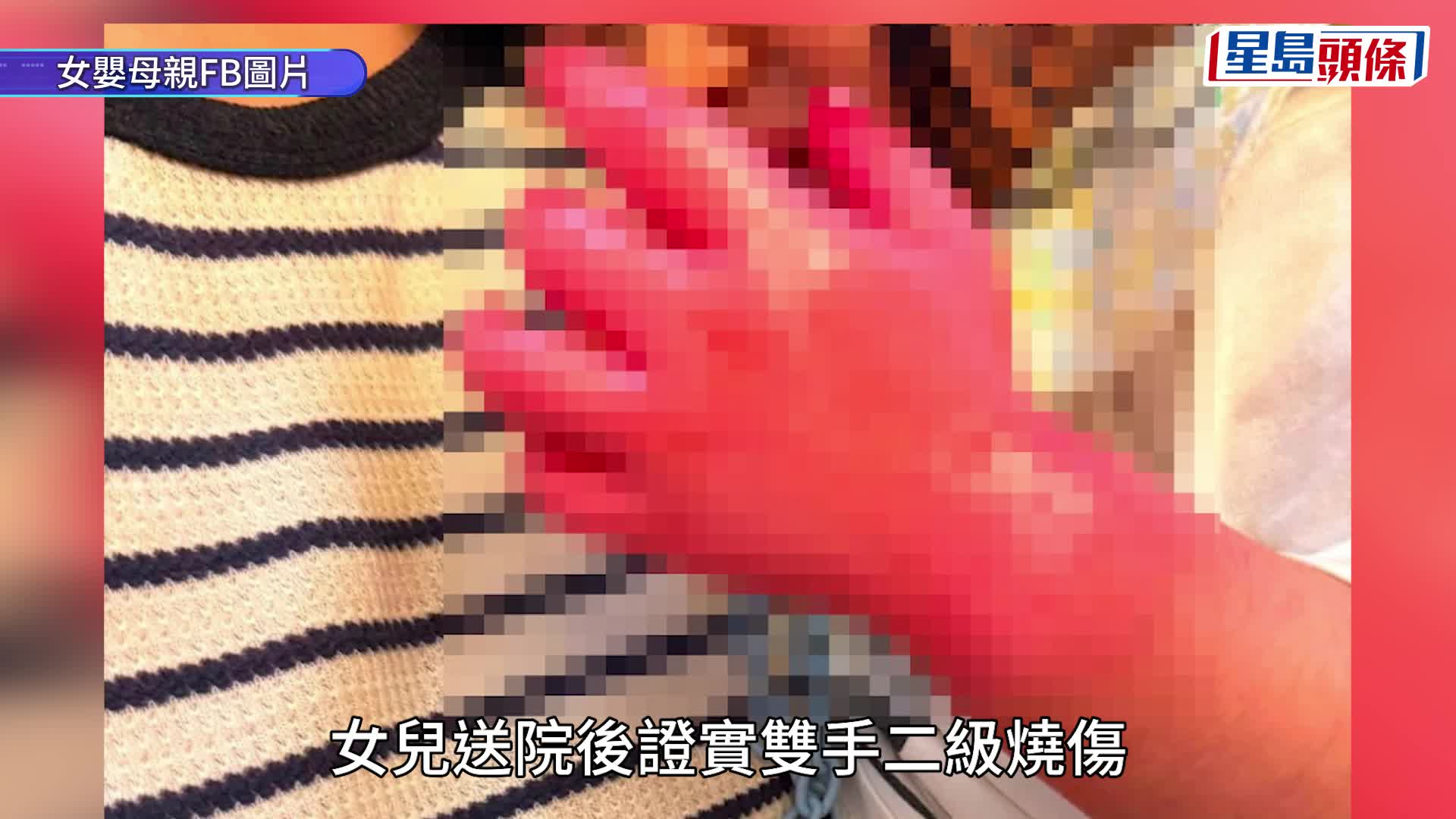 元朗23個月大女嬰雙手二級燒傷 母親控訴：點解要傷害BB女 印傭涉虐兒被捕