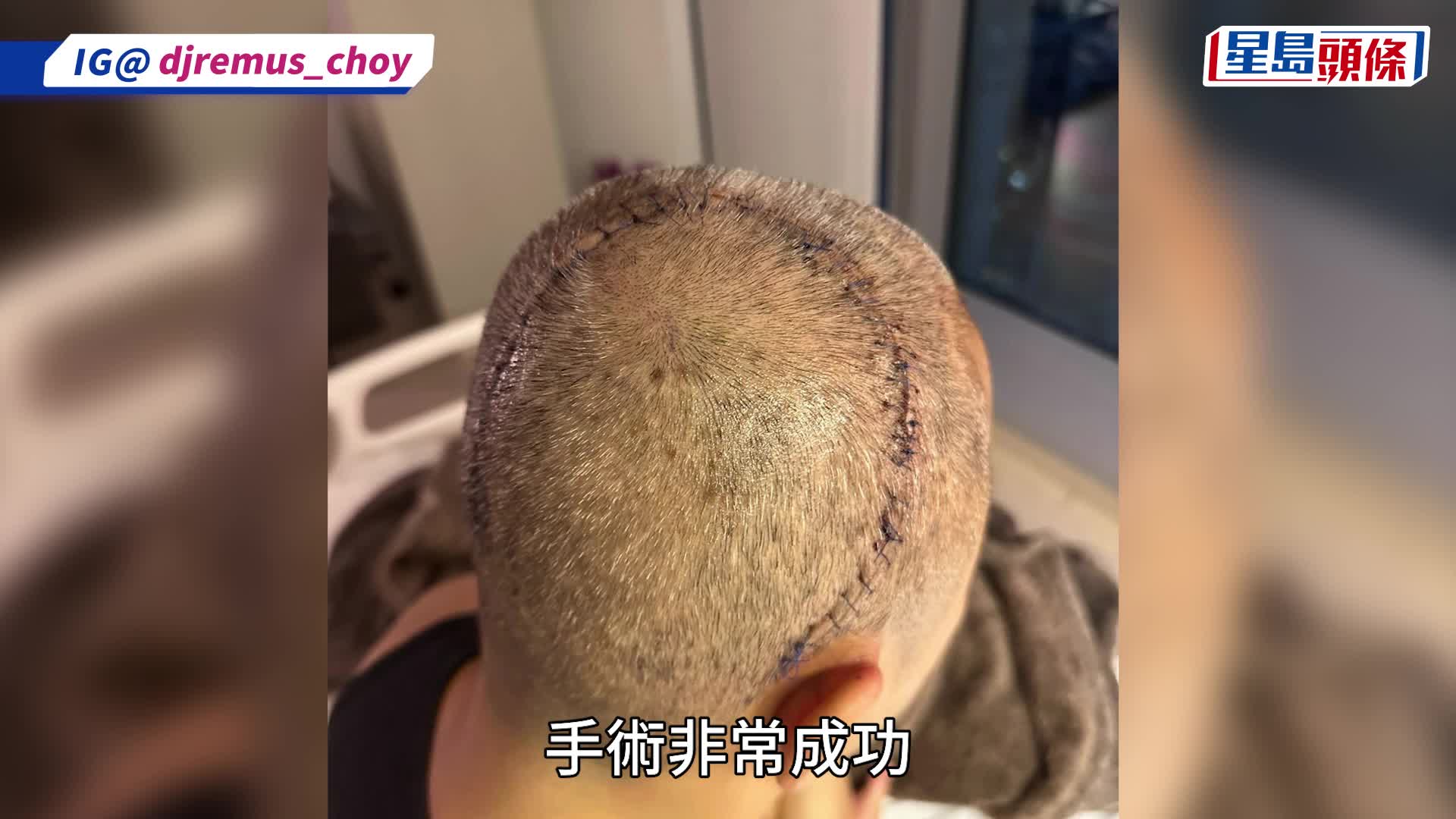 57歲蔡一傑驚爆完成腦瘤切除手術 頭頂U型傷口照觸目驚心