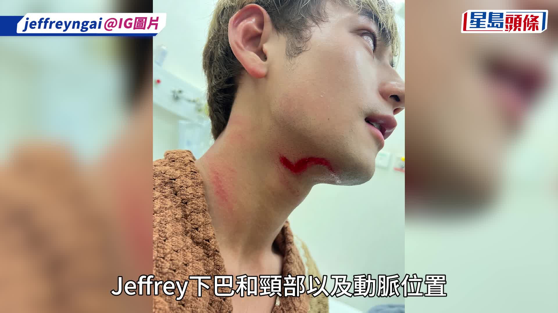 魏浚笙拍戲嚴重意外重傷近毀容 頸部近動脈現駭人傷痕：個腦一片空白