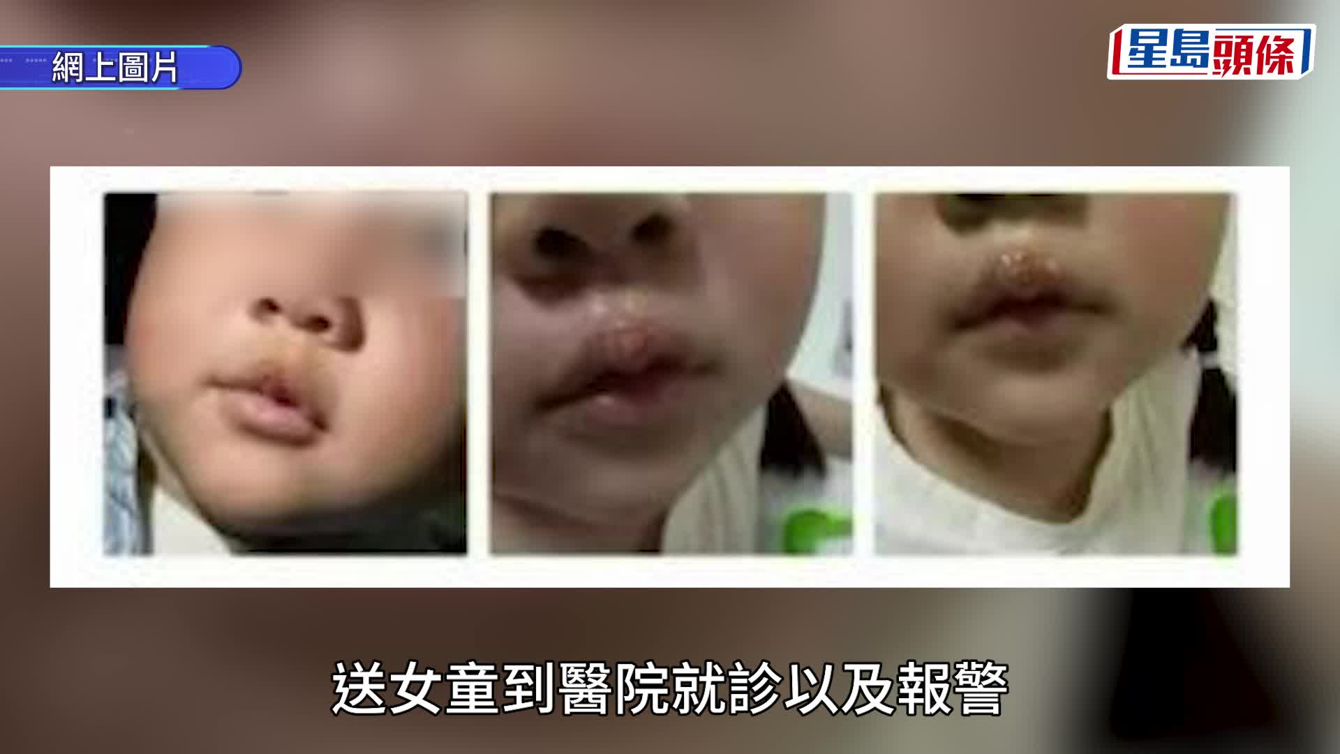 幼稚園虐童︱恐怖女教師熱熔膠槍當刑具  學生嘴唇流膿家長憤怒